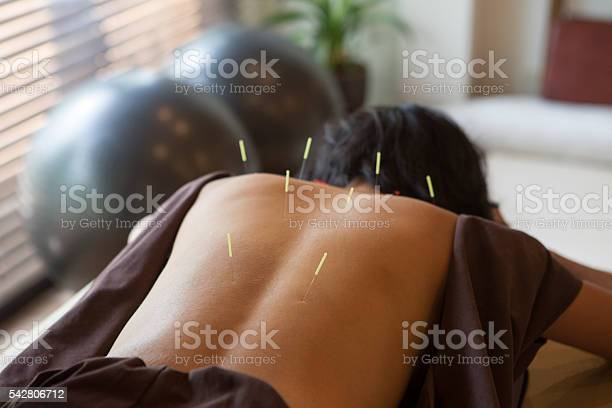 acupuncture for back pain